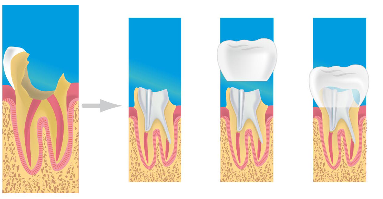 prothèses dentaires Bron