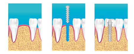 implant dentaire bron